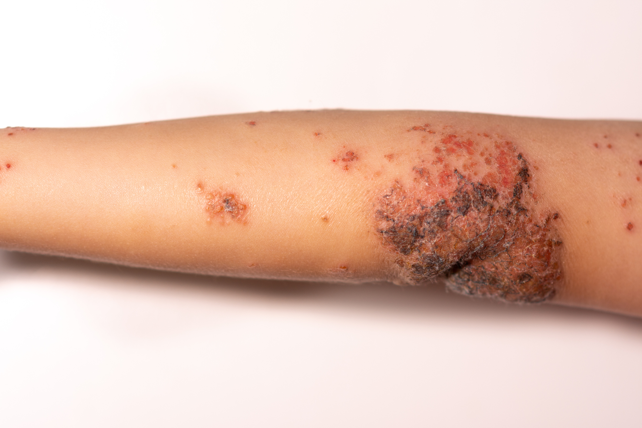 What Is Like Impetigo