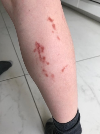 Une image contenant personne, Chair, blessure, Membre Le contenu généré par l’IA peut être incorrect.